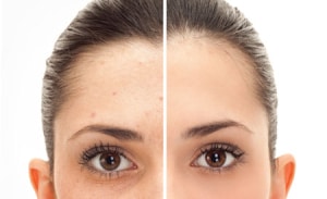 Laser Pigmentation removal | Grand Beauty Med Spa Tampa